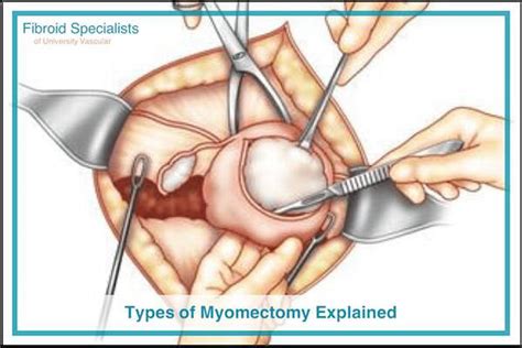 Types of Myomectomy: Hysteroscopic, Laparoscopic, Abdominal, & More