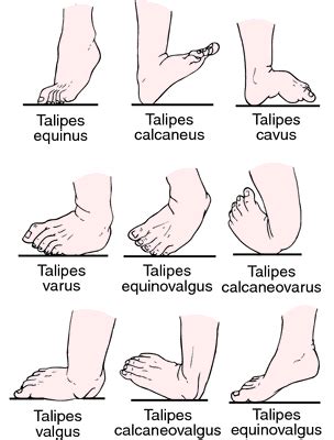 Valgus deformity | definition of Valgus deformity by Medical dictionary ...