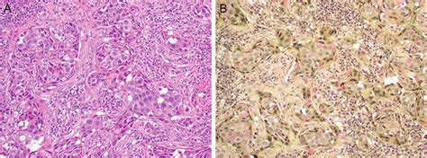 Mucoepidermoid carcinoma. a The tumor is composed of three populations ...