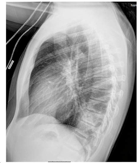 Normal Lateral Chest Xray