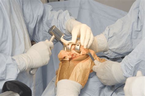 Who are orthopaedic surgeons and what do they do? — Medipulse: Best ...