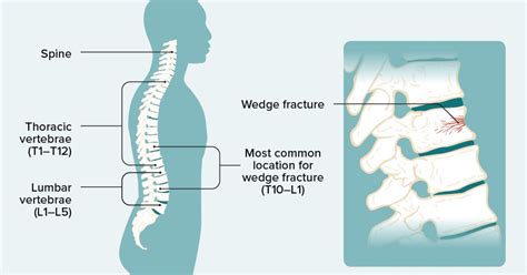 Vertebral Wedging: Symptoms, Diagnosis, and Treatment