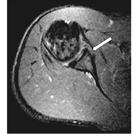 Classic Bankart Lesion. MRI proton density weighted fat saturated SE ...