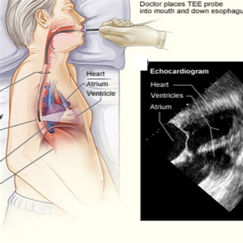 Echocardiography- TTE TEE