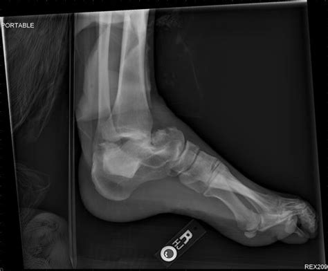 Types Of Talus Fractures