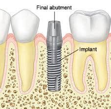 3 Phases of a Dental Implant | Inspired Dental - La Vista and Papillion ...