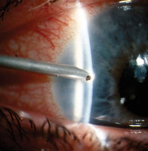 Clinical Pearls in Corneal Foreign Body Removal