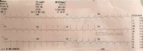 Bifascicular Block | ECG Guru - Instructor Resources