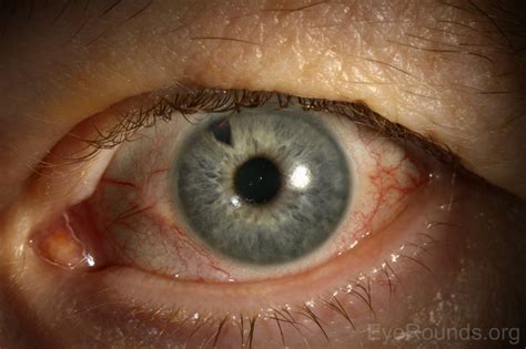 Posner-Schlossman Syndrome (Glaucomatocyclitic Crisis)