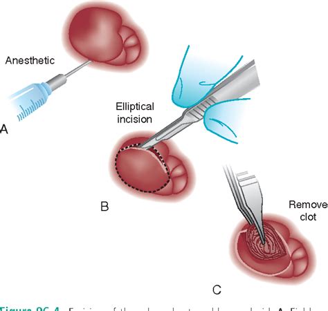 Thrombosed Hemorrhoid Incision And Drainage