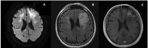 MR Brain: (A) Axial Diffusion Weighted Image (DWI) showing restricted ...