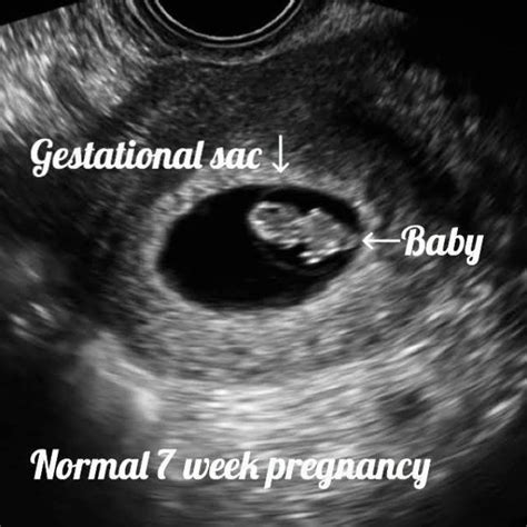 Molar pregnancy information. Ultrasound included. - Ultrasoundfeminsider