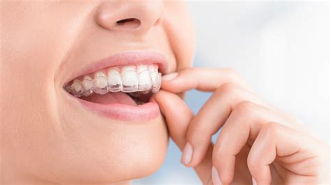 Invisalign Attachments: A Comprehensive Guide