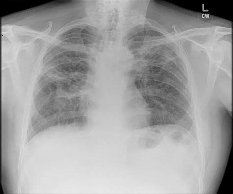 Stage 4 disease-Pulmonary fibrosis. | Download Scientific Diagram