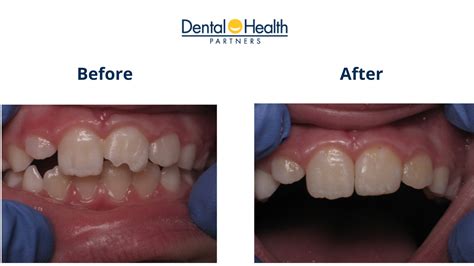 Composite Bonding | Before and After Tooth Restoration - Dental Health ...