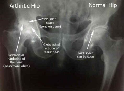 Osteophytes Hip