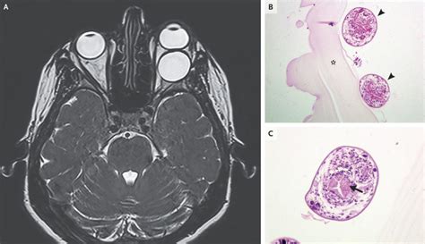 A Rare Presentation of Hydatid Cyst - MEDizzy Journal