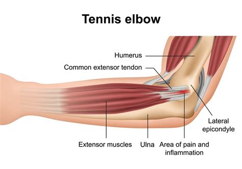 Flexor Tendonitis Of The Elbow: Anatomy, Symptoms, Causes Treatments ...