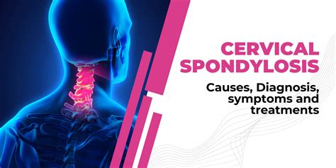 Cervical Spondylosis: Causes, Diagnosis, Symptoms, and Treatments | The ...