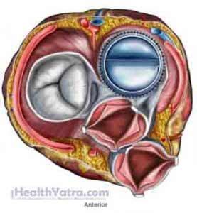 Prosthetic Heart Valve Thrombosis Definition, Causes, Symptoms ...