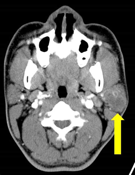 Pleomorphic adenoma of parotid gland – Radiology Cases