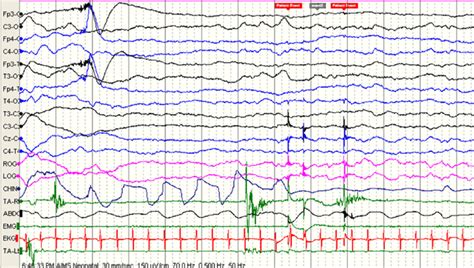 e Ictal EEG of a child with benign sleep myoclonus in the modified ...