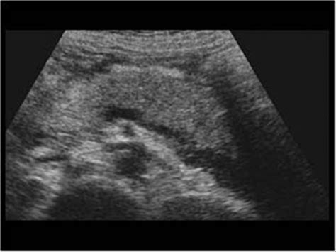 Acute Pancreatitis Ultrasound Findings