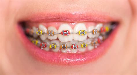 A Complete Guide to Different Color Braces and Ideas for Los Angeles