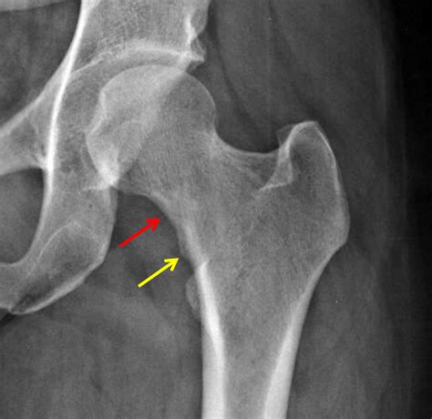 Femoral Neck Stress Fracture MRI