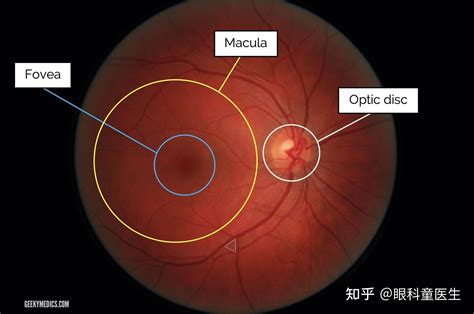 眼底彩照和眼底造影阅片 - 知乎