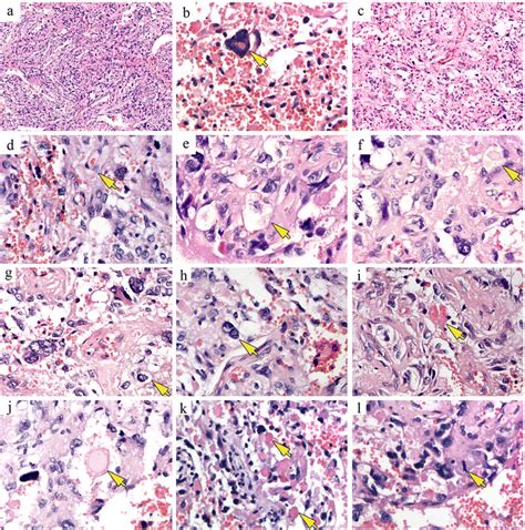 Histological features of angiomatous pleomorphic xanthoastrocytoma. a ...