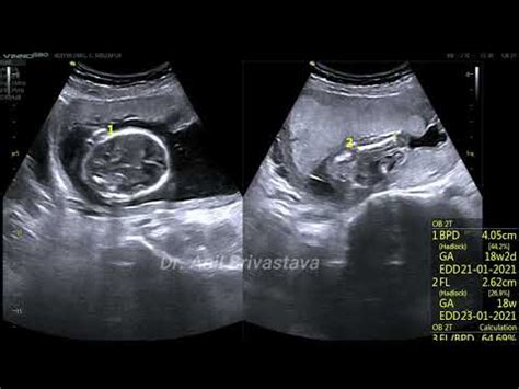 Pregnancy in septate uterus in 1st and 2nd trimester - YouTube