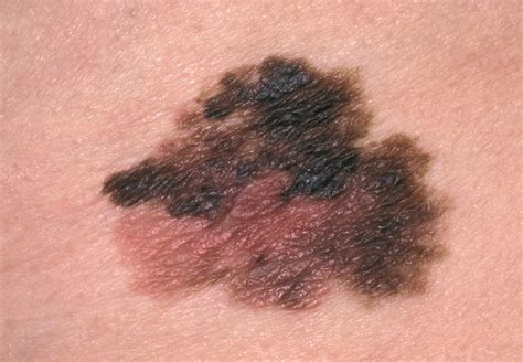 Combination immunotherapy for advanced melanoma gets early approval ...