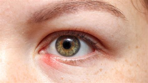 What causes a stye, risks and how can you treat and prevent | HealthShots