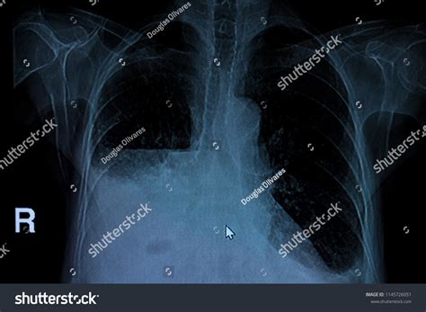 Ct Scan Hydropneumothorax Stock Photo 1145726051 | Shutterstock