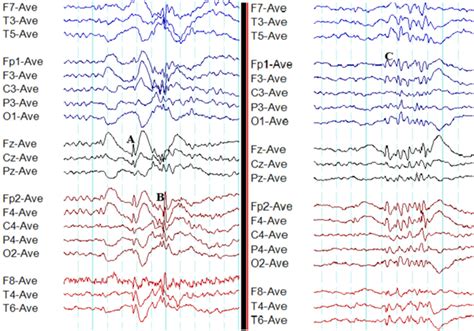 Abnormal eeg - qlerorain