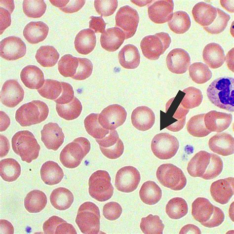 Common Rbc Inclusions Diagram Medical Laboratories | The Best Porn Website