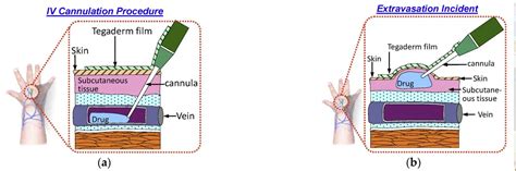 Difference Between Infiltration And Extravasation - Relationship Between