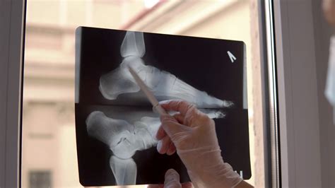 Doctor Examines X-ray Film Of Broken Foot Stock Footage SBV-346638852 ...