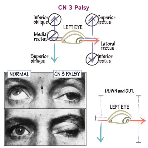 Neuroanatomy Glossary: 3rd Nerve Palsy | Draw It to Know It