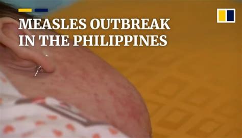 Philippine health officials declare Measles outbreak in Metro Manila ...