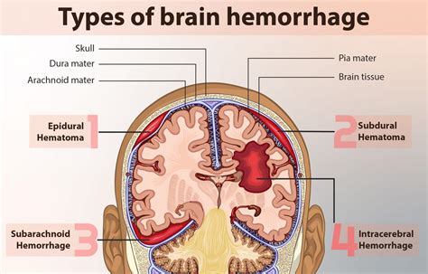 Subdural and epidural hematomas