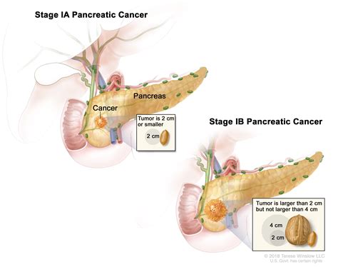 Pancreatic Cancer | UCSF Department of Surgery