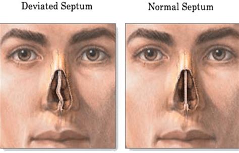 What is a Deviated Septum? Know More about its Surgery and Recovery