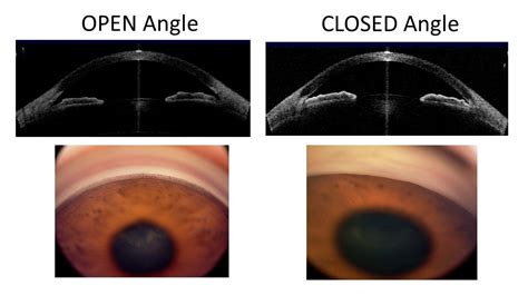 Angle Closure Glaucoma Vs Open Angle