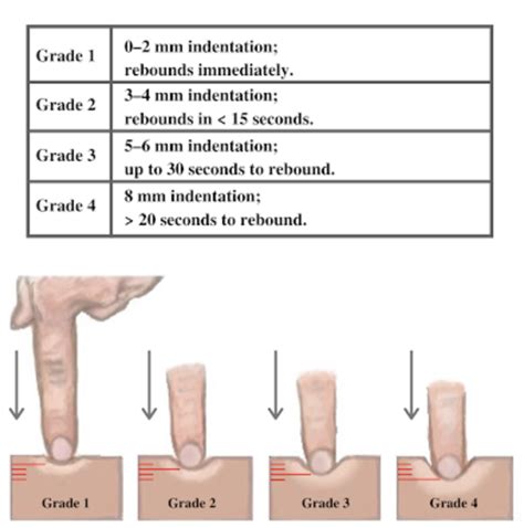 Skin: Palpation – Introduction to Health Assessment for the Nursing ...