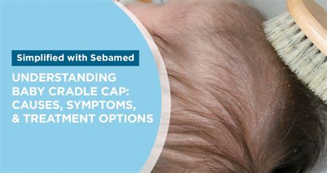 Understanding Cradle Cap: Causes, Symptoms & Treatment