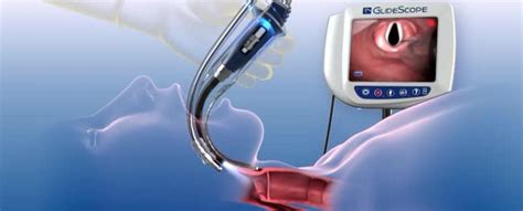 Video: GlideScope® Video Laryngoscope