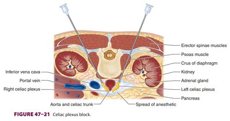 Celiac Plexus Block