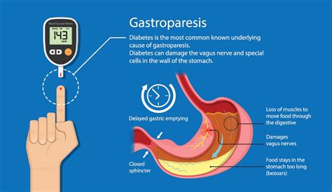 Diabetic Gastroparesis – Symptoms, Diagnoses, and Treatment - Breathe ...